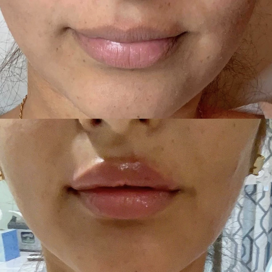 Botox before and after