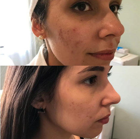 Before and after microneedling results showing reduced acne scars, smoother skin texture, and improved facial complexion.