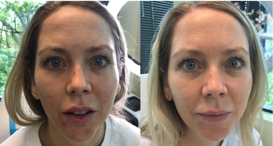 Microneedling before and after results showing smoother skin texture and a more even complexion.