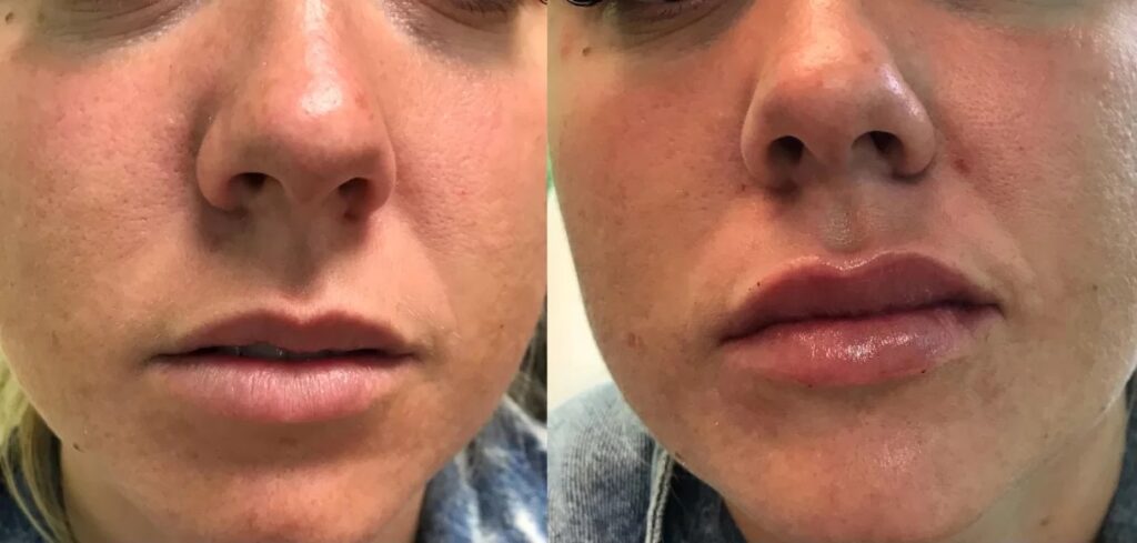 Lip Filler Before and After Results