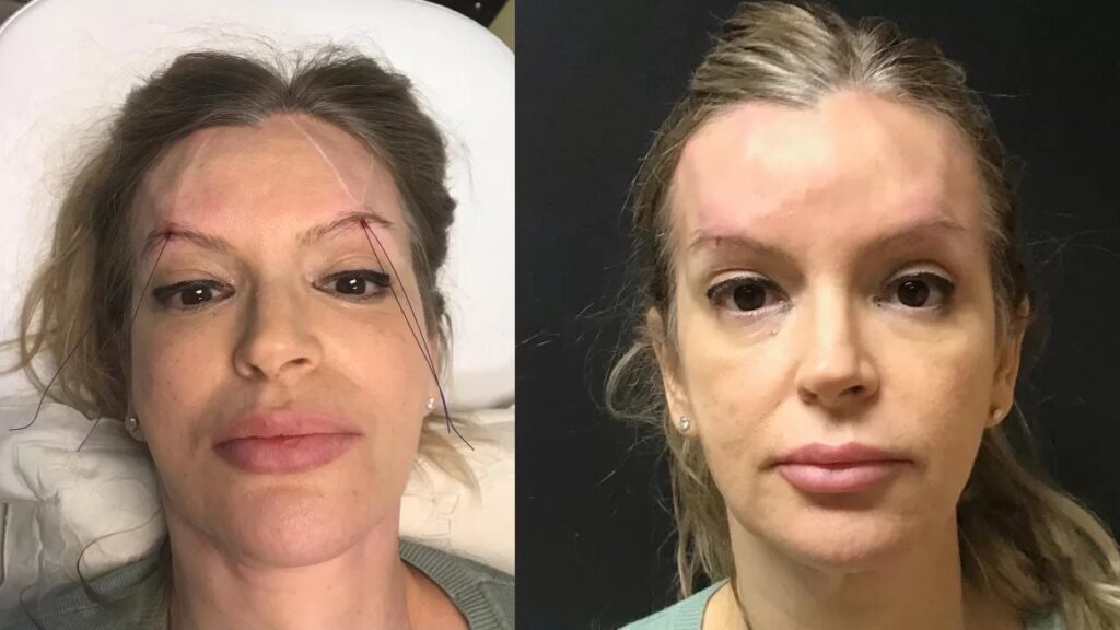 PDO thread lift before after results