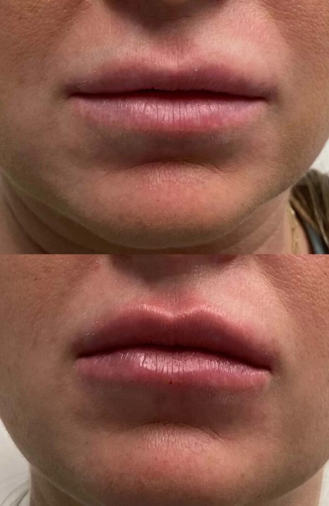Dermal Fillers before after results